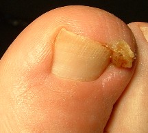 Diseases of the Nails: Slideshow – Medscape
