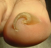 nail disease