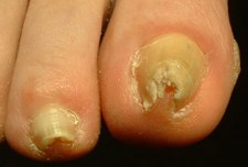 nail disease